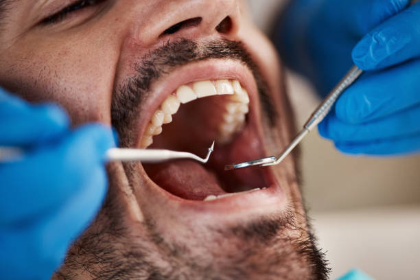 Best Emergency Broken Tooth Repair in St Henry, OH